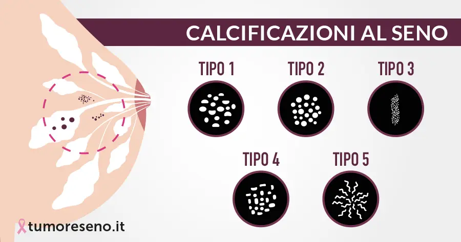 Calcificazioni al seno