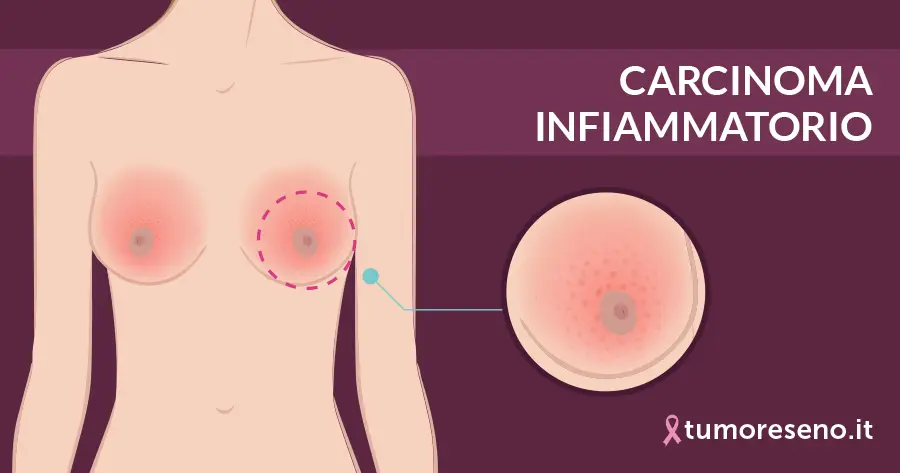 Carcinoma infiammatorio seno