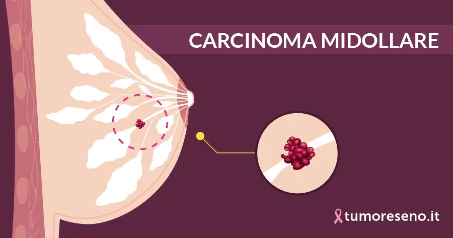 Carcinoma midollare