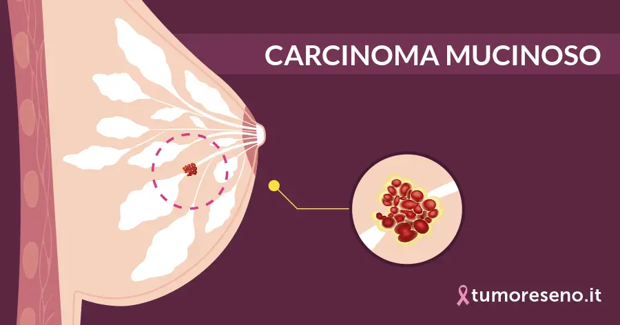 Carcinoma mucinoso