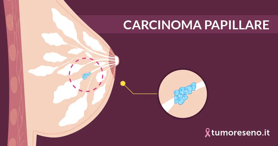 Carcinoma papillare