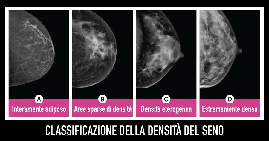 Classificazione della densità del seno