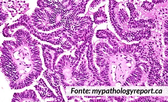 Come si presenta il carcinoma papillare