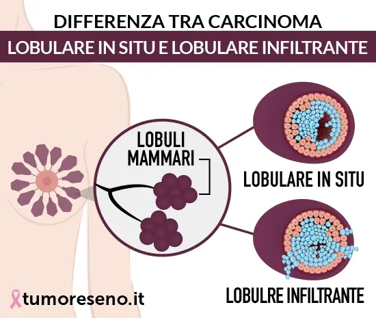 differenza tra carcinoma lobulare in situ e lobulare infiltrante