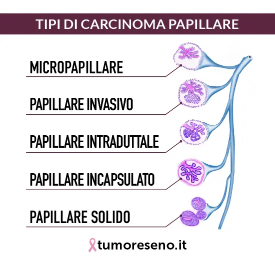 Tipi di carcinoma papillare