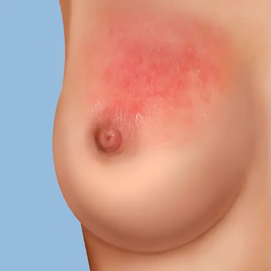 Tumore al seno sintomi immagini arrossamenti della pelle
