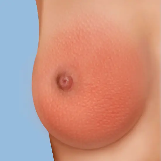 Tumore al seno sintomi immagini pelle a buccia d'arancia