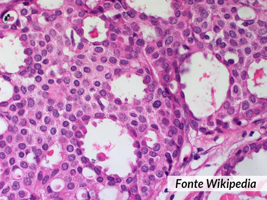 carcinoma cribriforme immagine istologico