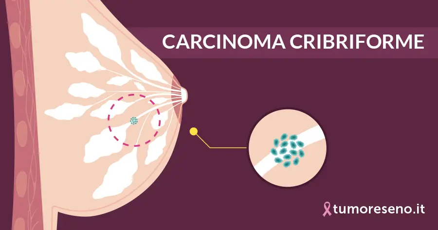 carcinoma cribriforme