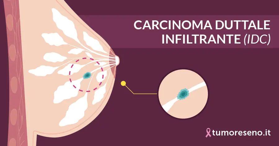 carcinoma duttale infiltrante