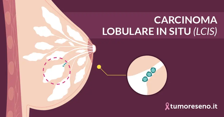 carcinoma lobulare in situ