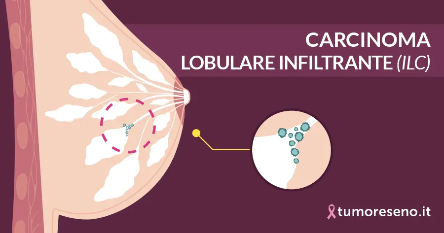 carcinoma lobulare infiltrante