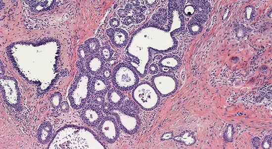 carcinoma tubulare della mammella immagine istologica
