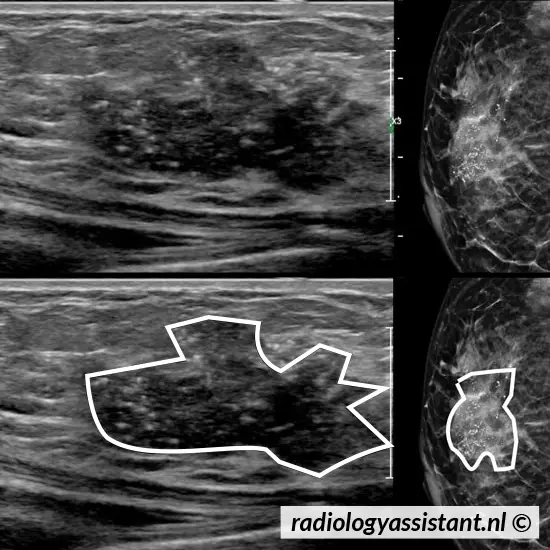 come appare un tumore al seno in ecografia e mammografia