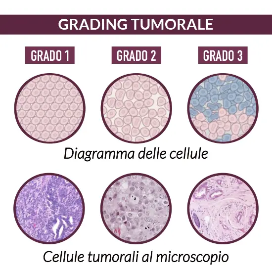 grading tumorale del tumore al seno