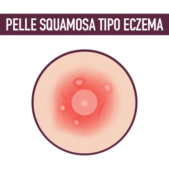 pelle squamosa capezzolo