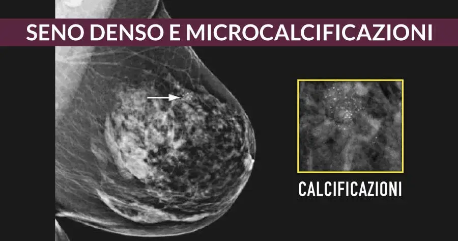 Seno denso e microcalcificazioni