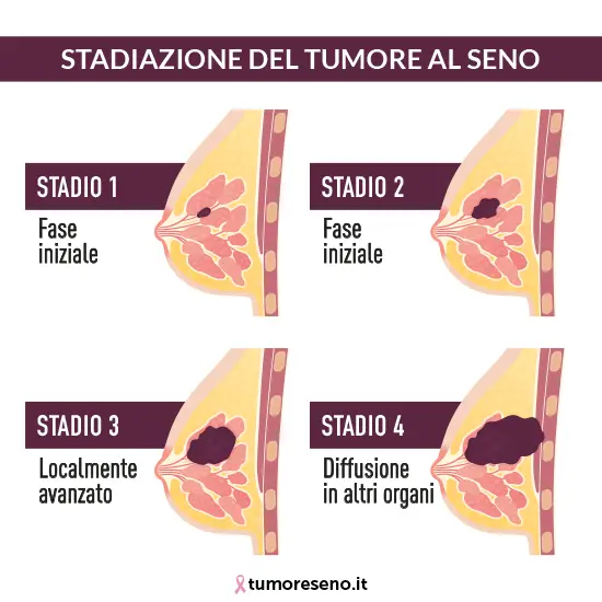 stadi del tumore al seno immagine