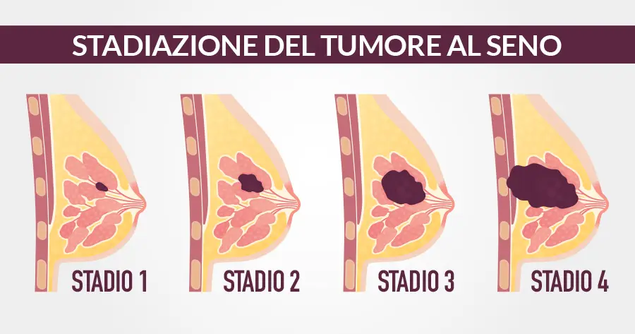 stadiazione tumore mammella