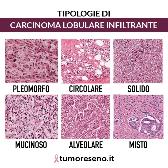 tipologie di carcinoma lobulare infiltrante