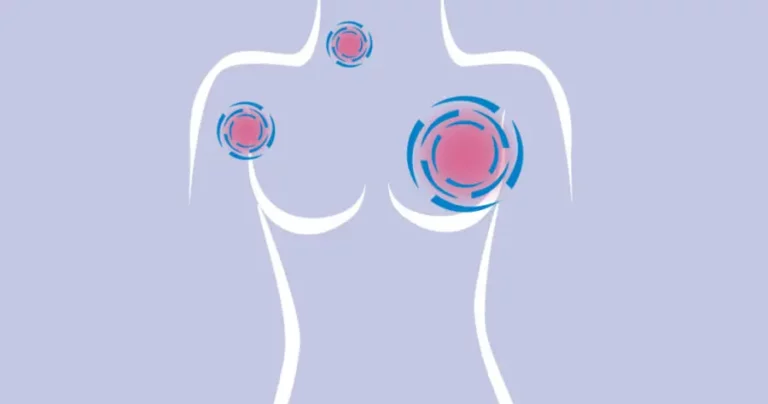 tumore-al-seno-metastasi-sintomi copia