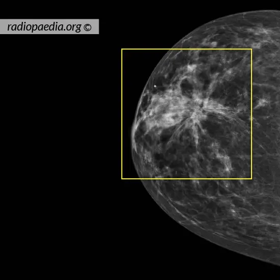 adenosi sclerosante immagine mammografia