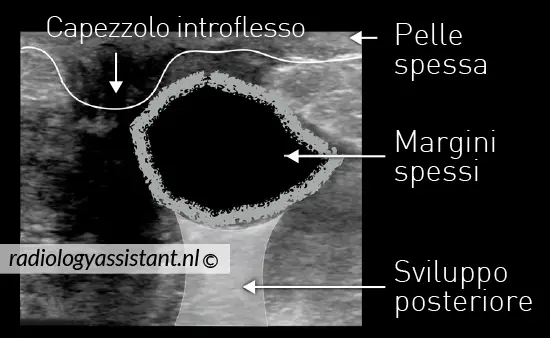 ascesso mammario immagine ecografica 1