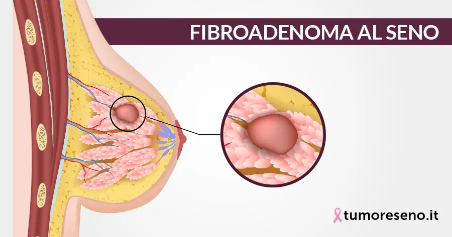 Fibroadenoma