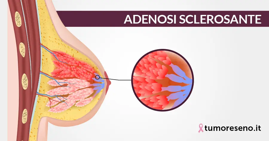 adenosi sclerosante