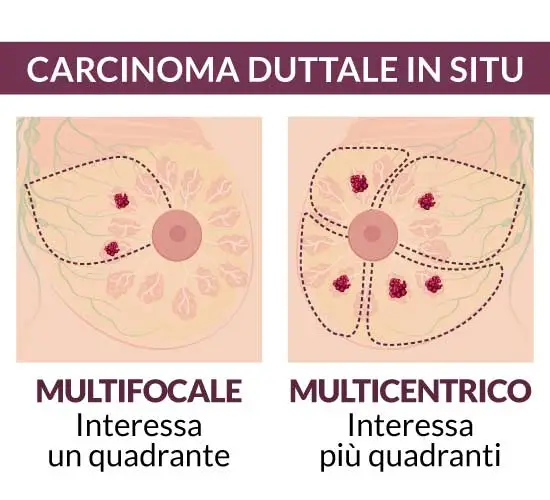 carcinoma duttale in situ multifocale multicentrico