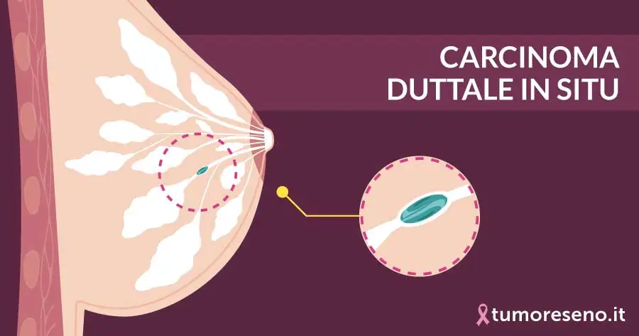 carcinoma duttale in situ