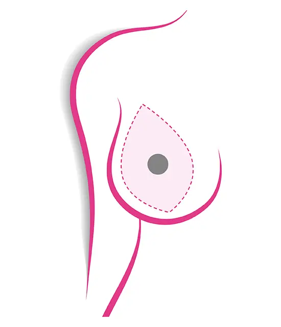 chirurgia mammaria mastectomia