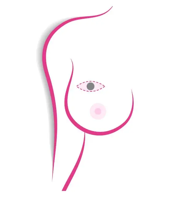 chirurgia mammaria nodulectomia