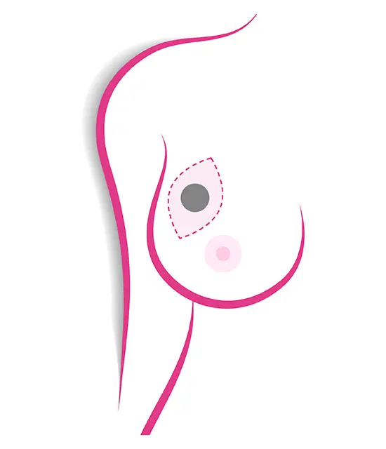 chirurgia mammaria quadrantectomia