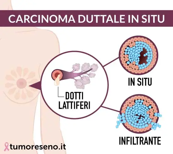 differenza tra carcinoma duttale in situ e duttale infiltrante