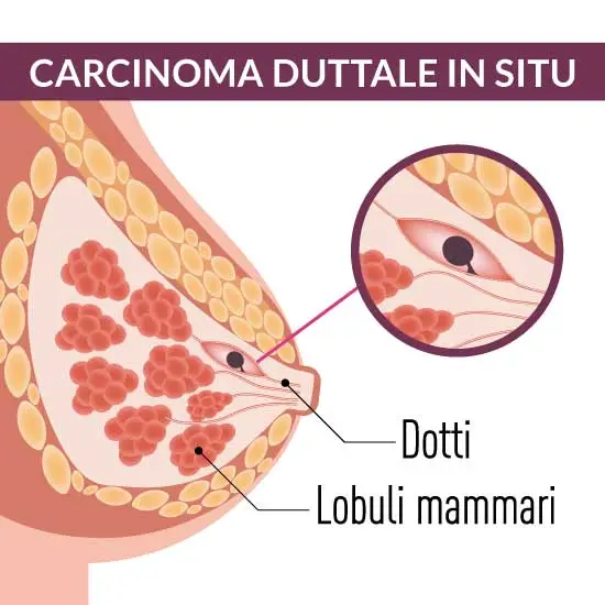 immagine del carcinoma duttale in situ