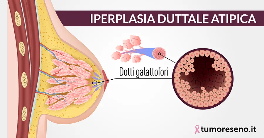 iperplasia duttale atipica