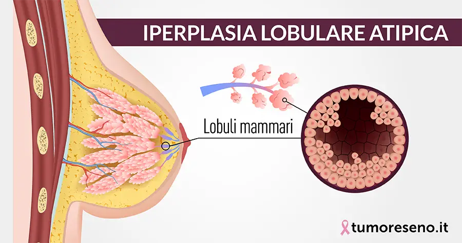 iperplasia lobulare atipica