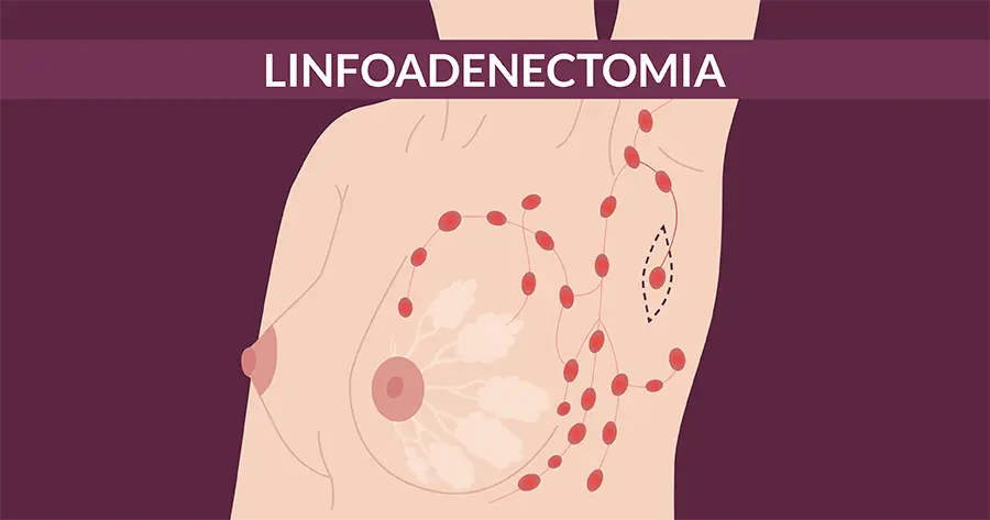 linfoadenectomia ascellare