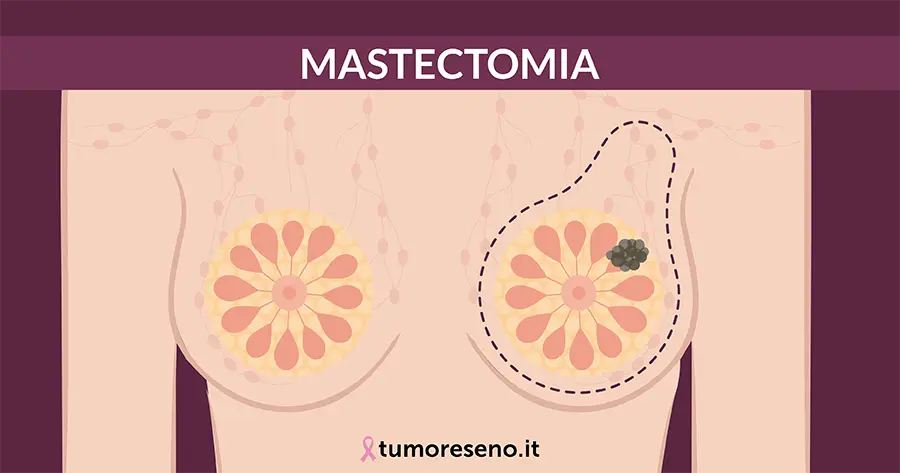 mastectomia