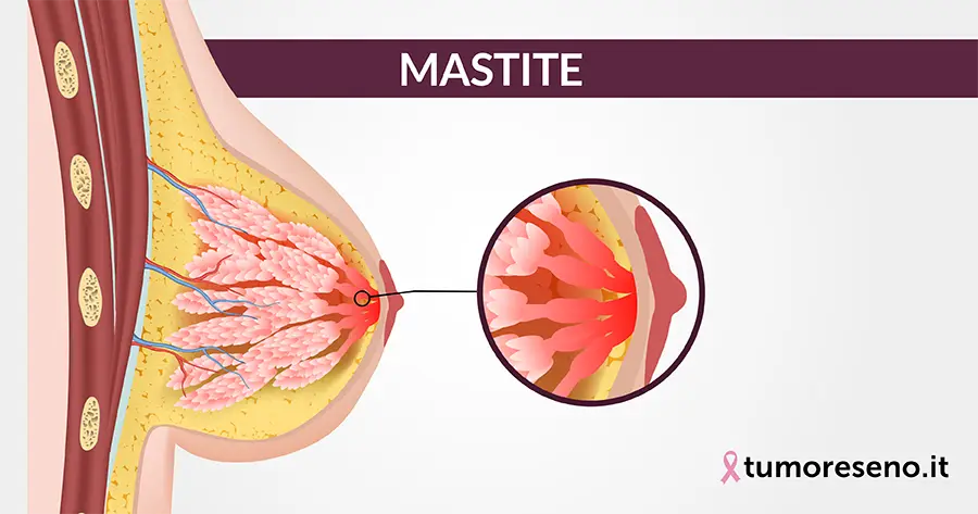 mastite