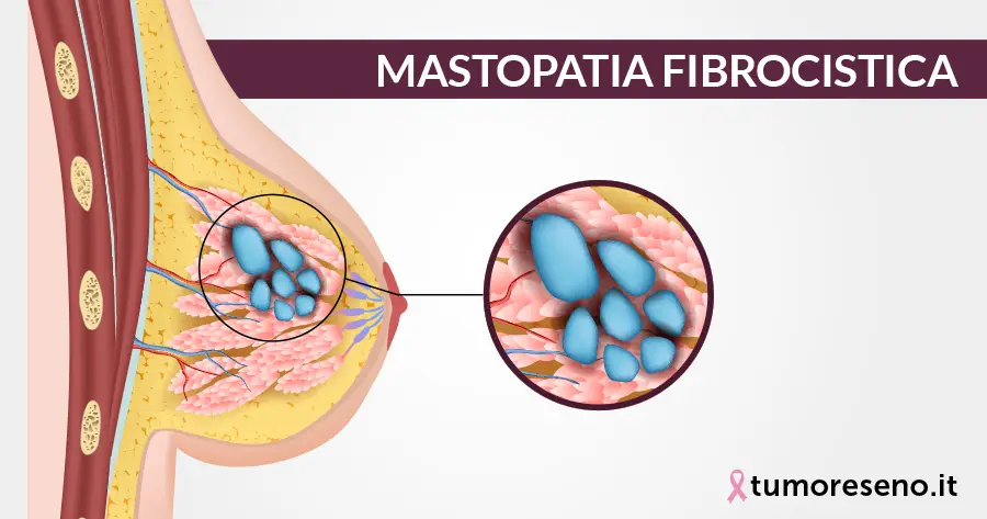 mastopatia fibrocistica