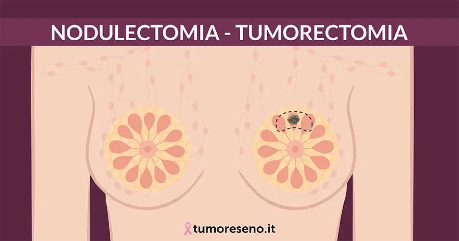 nodulectomia o tumorectomia