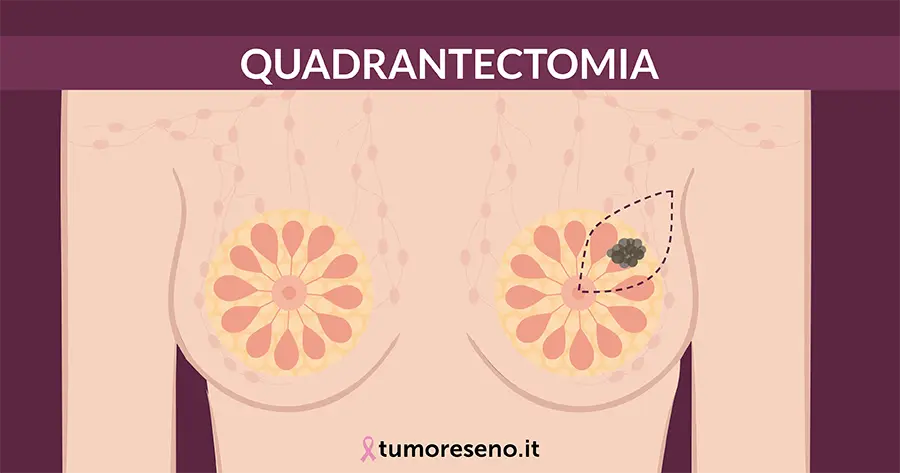 quadrantectomia per il tumore al seno