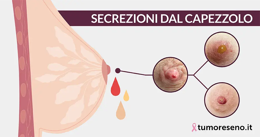 secrezioni dal capezzolo