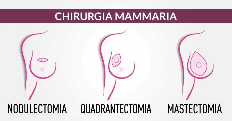 tecniche chirurgiche asportazione del tumore al seno