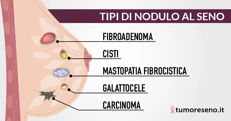 tipi di nodulo al seno