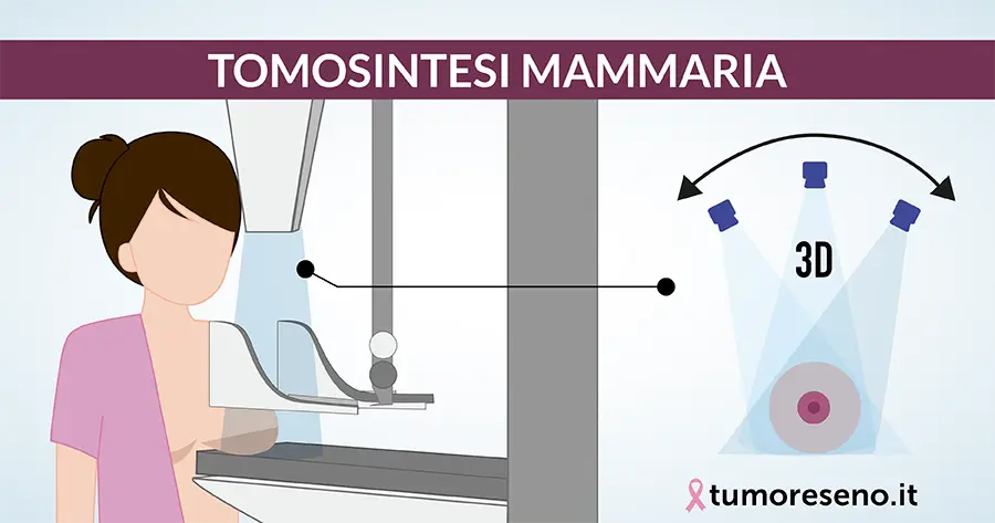 tomosintesi mammaria