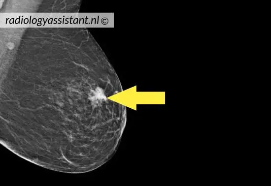 tumore al seno immagini mammografiche
