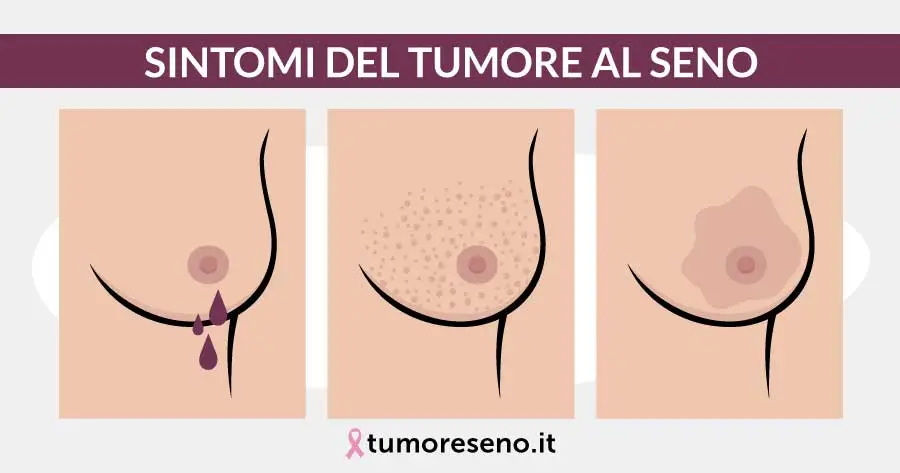 tumore al seno sintomi